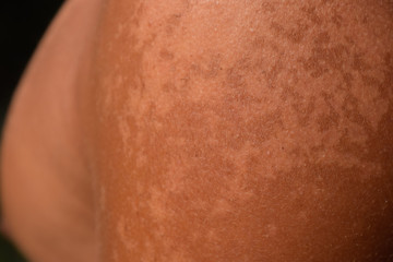 Sunburn on the skin of the shoulders. Exfoliation, skin peels off. Dangerous sun tan