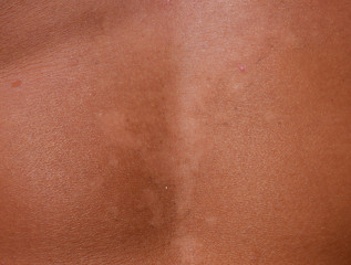 Sunburn on the skin of the stomach. Exfoliation, skin peels off. Dangerous sun tan