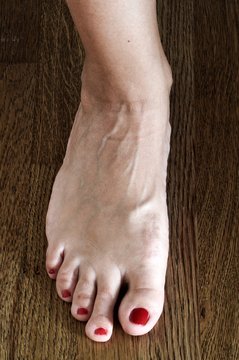 hallux valgus after surgery