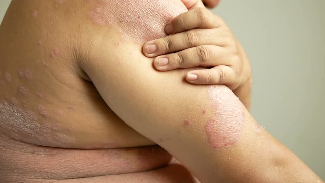 Men is their hands to scratch the wound. Diseases caused by abnormalities of the lymph. Psoriasis is a skin disease.