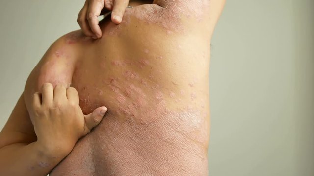 Men is their hands to scratch the wound. Diseases caused by abnormalities of the lymph. Psoriasis is a skin disease.