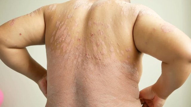 Men is their hands to scratch the wound. Diseases caused by abnormalities of the lymph. Psoriasis is a skin disease.