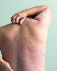 Diseases caused by abnormalities of the lymph