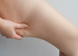 Female legs thighs with cellulite. Skin problem, body care, overweight and dieting concept,...