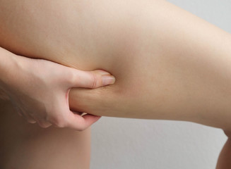 Female legs thighs with cellulite. Skin problem, body care, overweight and dieting concept,...