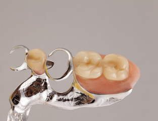 Klammer Prothese Teilansicht