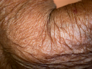 Wrinkles on The Skin of Elbow Joint