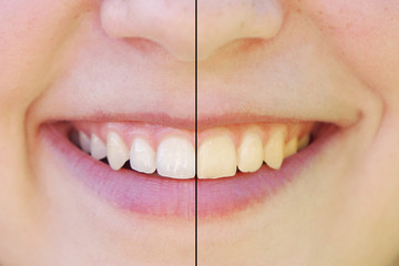 teeth whitening before and after concept. comparision between yellow and white teeth side by side.