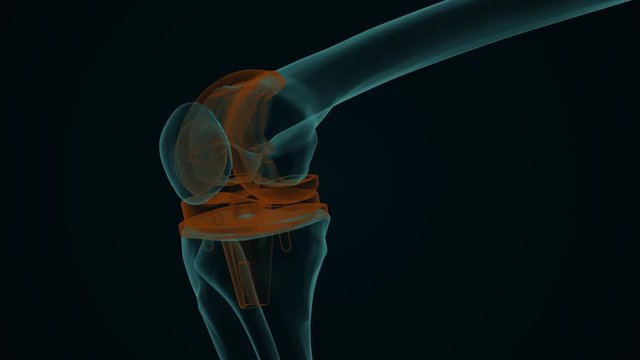 X-ray of a human knee with knee replacement isolated on a black background 