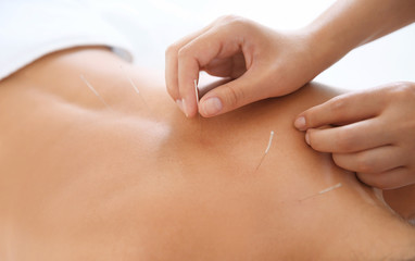 Young woman undergoing acupuncture treatment in salon, closeup - obrazy, fototapety, plakaty