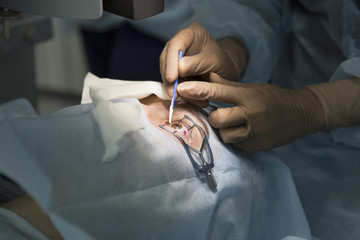 Laser surgery for vision correction