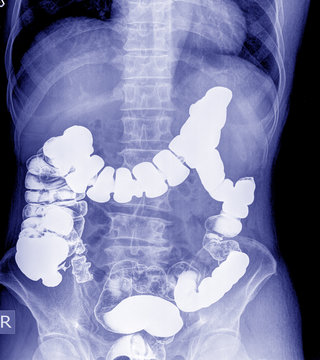 Barium enema of a man demonstrated the normal rectum and cecum.