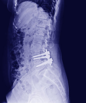 X-ray of the pelvis and spinal column ,side view Post Open Reduction Internal Fixation with internal bone rod, plate and screw by Orthopedic surgeon.