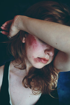 Mujer maltratada con golpes recientes 