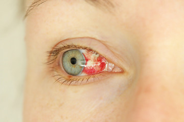 Bloodshot eye. Woman with burst blood vessel in eye. Very red bloody eyeball. Bleeding damage in...