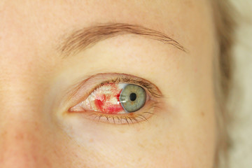 Bloodshot eye. Woman with burst blood vessel in eye. Very red bloody eyeball. Bleeding damage in...