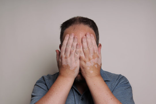 man affected by Vitiligo skin condition hiding his face