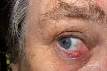 Senior woman with eye infection