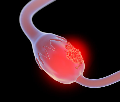 3d Illustration Of Ovarian Cancer