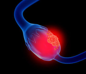 3d illustration of ovarian cancer