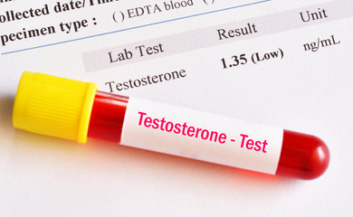 Abnormal low testosterone hormone test result 