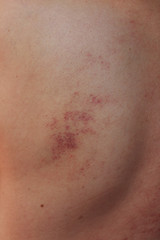 bruises that remain after the ancient Chinese method of massage with a scraper. back area