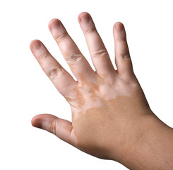 Vitiligo skin disease