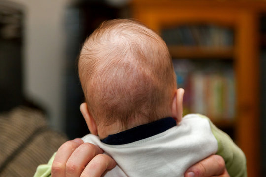 Back Of Head Of A Baby Who Had A Possible Diagnosis Of Craniosynostosis