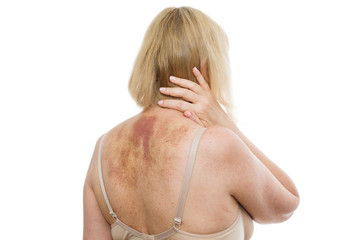 A bruise on the back, a woman with extensive hematoma after a massage