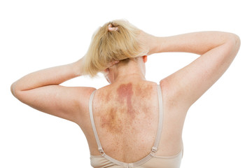 A bruise on the back, a woman with extensive hematoma after a massage