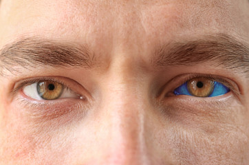 Young man with contact lenses, closeup