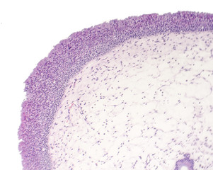 Inflammatory polyp, light micrograph, photo under microscope