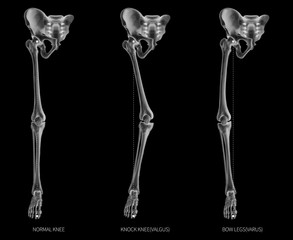 Alignment types of disease lower half limbs or leg bone problem-Normal-Knock knee-Bowlegs or Valgus and Varus knee-3D-human anatomy-medical diagram-educational concept-black and white x-ray color film - obrazy, fototapety, plakaty