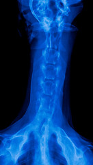 X-ray film of dog anterior view closed up in neck bone pain areas or cervical vertebrae- veterinary...