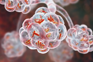 Bacteria pneumonia, medical concept. 3D illustration showing rod-shaped bacteria inside alveoli