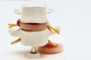Artificial human herniated lumbar disc on white background