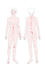  Acupuncture. Treatment of osteochondrosis. Templates of a woman's figure with points for massage. Front view and back. Vector illustration.