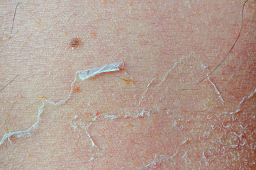 dry skin texture peeling off
