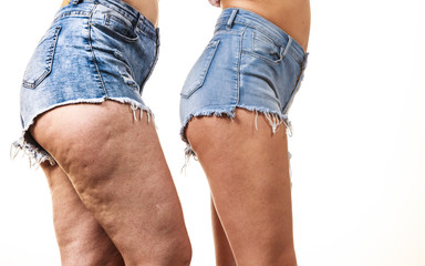 Comparison of legs with and without cellulite - obrazy, fototapety, plakaty