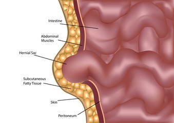 Hernia in the abdomen and groin