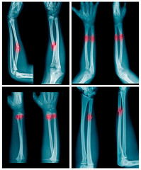 Collection of X-ray image of Forearm bone fracture in child's (Radius bone, Ulna bone)