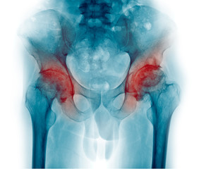 reverse Xray image of patient who have pain at hip joints, show osteoarthritis and inflammation at...