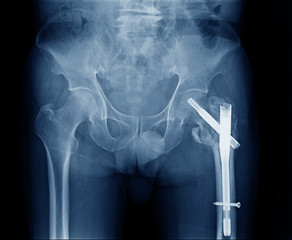 X-ray image of left side human hip fracture neck of femur bone. Open Reduction Internal Fixation...