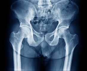 X-ray image of the normal hips joint , pelvis and spinal column of a man