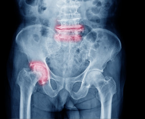X-ray image of painful hip in man present Osteoarthritis right hip joint and spinal stenosis at red area mark