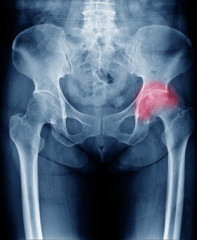 X-ray image of chronic painful hip in woman present Osteoarthritis left hip joint at red area mark