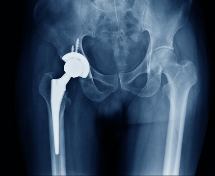 X-ray scan image of hip joints with orthopedic hip joint replacement or total hip prosthesis on right side implant head and screws in human skeleton in blue gray tones.