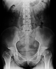 spine , hip joint , pelvis of a human body on x-ray front view.