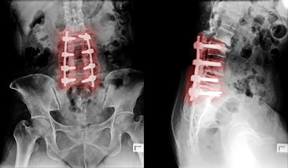 X-ray image of lumbar spine postoperative treatment for degenerative lumbar disc disease by decompression and fix by iron rod and screws
