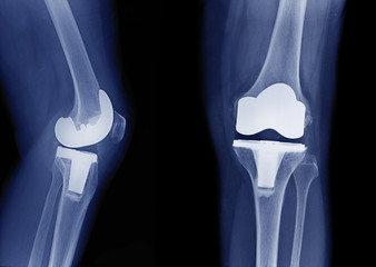 x-ray image of total knee arthroplasty / total knee replacement side view and front view show metallic joint implant in bone fix knee Osteoarthritis (OA Knee)